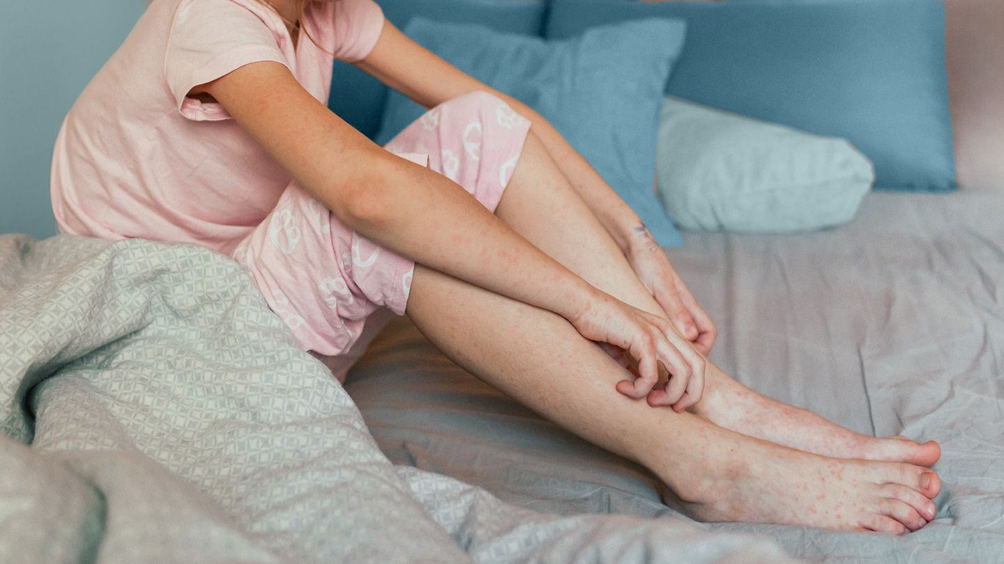 Does Itching Keep Them Up at Night? Here’s How to Manage Your Child’s Nighttime Atopic Dermatitis Flares