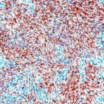 Expression of HHV-8 LANA in Pediatric Kaposi Sarcoma