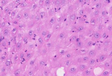 Hypoxia-induced EGR1 remodels neutrophils to suppress antitumor immunity | Science Immunology