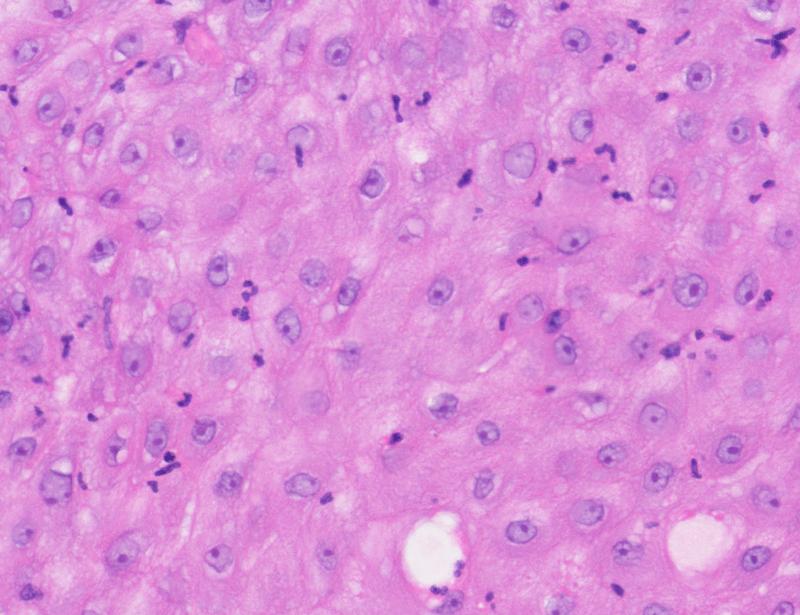 Hypoxia-induced EGR1 remodels neutrophils to suppress antitumor immunity | Science Immunology