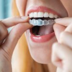Invisalign vs. Braces: Which Is Better?