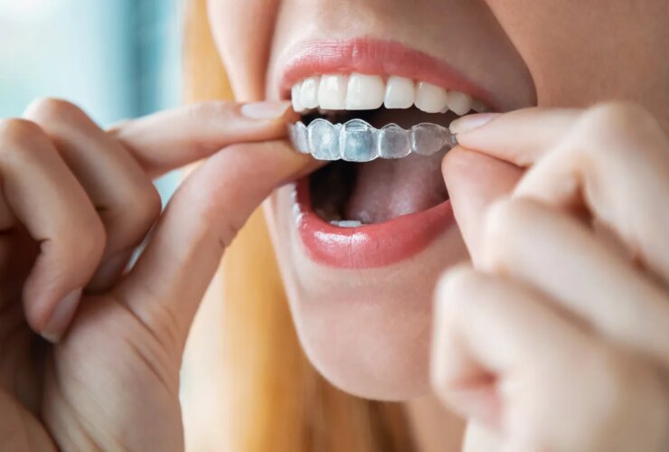 Invisalign vs. Braces: Which Is Better?