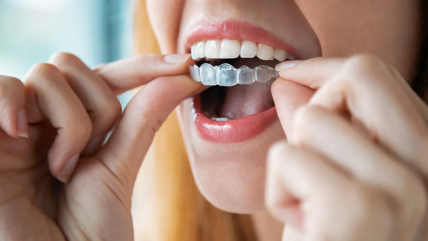 Invisalign vs. Braces: Which Is Better?