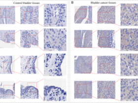 Multi-omics profiling identifies ESM1 as a key mediator of immunoevasion through the SPP1 pathway in bladder cancer