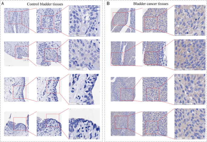 Multi-omics profiling identifies ESM1 as a key mediator of immunoevasion through the SPP1 pathway in bladder cancer