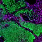 Brain organoid depicting neural stem cells in green and neurons in magenta. Both cell types are abundant, showing normal development.