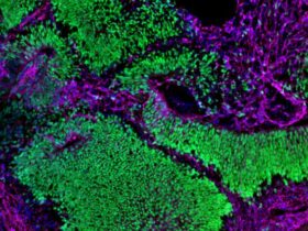 Brain organoid depicting neural stem cells in green and neurons in magenta. Both cell types are abundant, showing normal development.