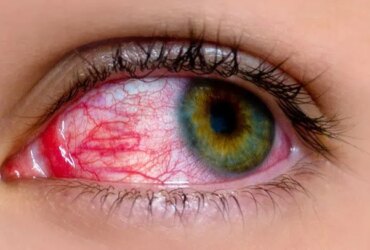 Pink Eye: Common Myths and Facts