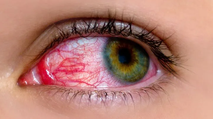 Pink Eye: Common Myths and Facts