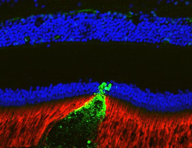 Colorful detailed scanning image of green cone of pseudodrusen poking through the retina.