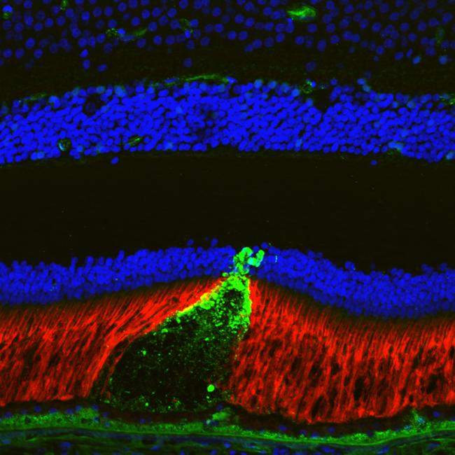Colorful detailed scanning image of green cone of pseudodrusen poking through the retina.