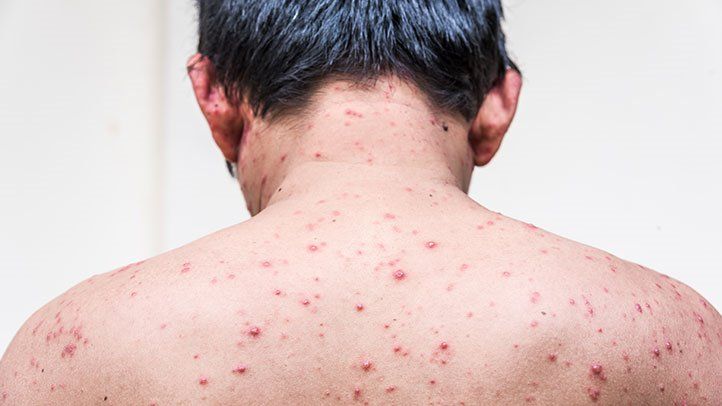 Chickenpox in Adults: Risk Factors, Symptoms, Complications, Treatment