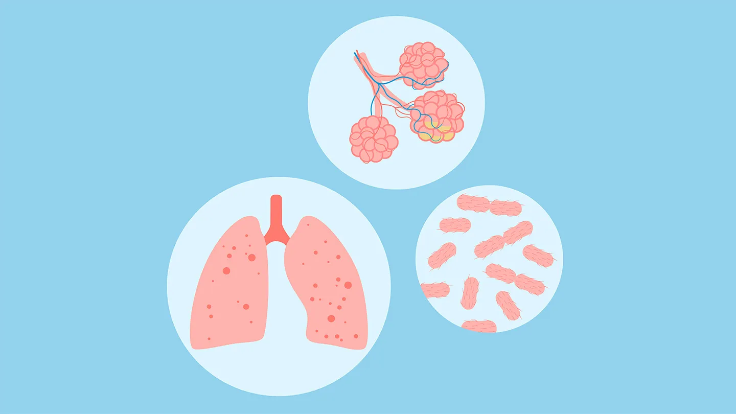 What Is a Klebsiella Pneumoniae Infection?