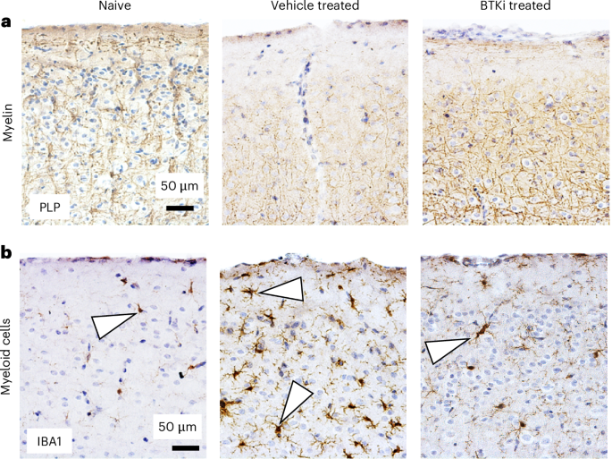 A molecular circuit at the brain border that drives gray matter injury