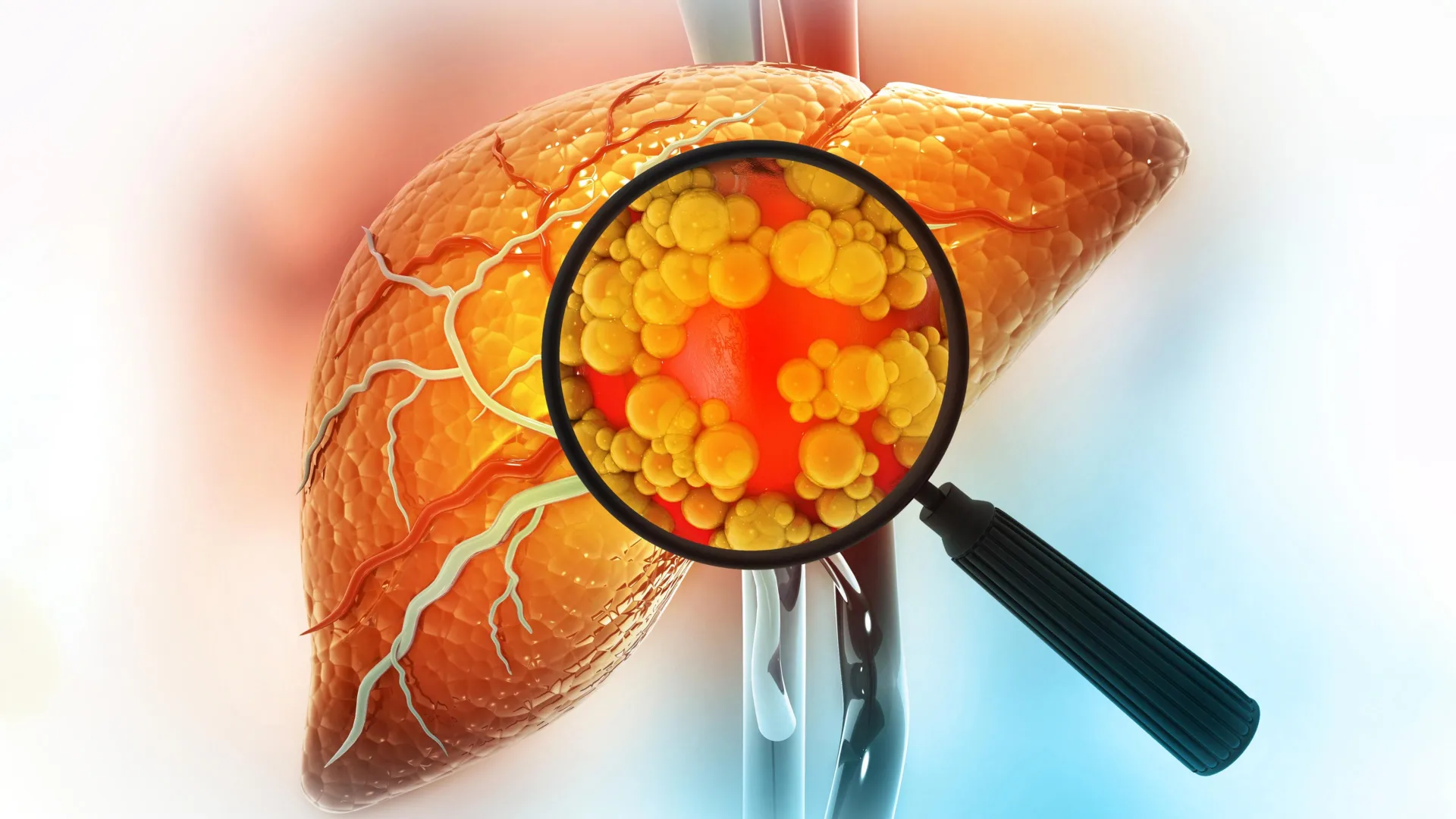 A simple drug pair may succeed where liver fibrosis treatments failed