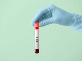 Is It Systemic Lupus Erythematosus (SLE) or Another Type of Lupus?