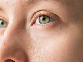 Dry Eye After LASIK or Vision Correction? What To Know