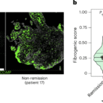 Fibroblasts determine treatment outcome in rheumatoid arthritis