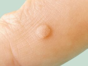 HPV Symptoms and Diagnosis