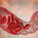 Long COVID may be fueled by inflammation and tiny clots