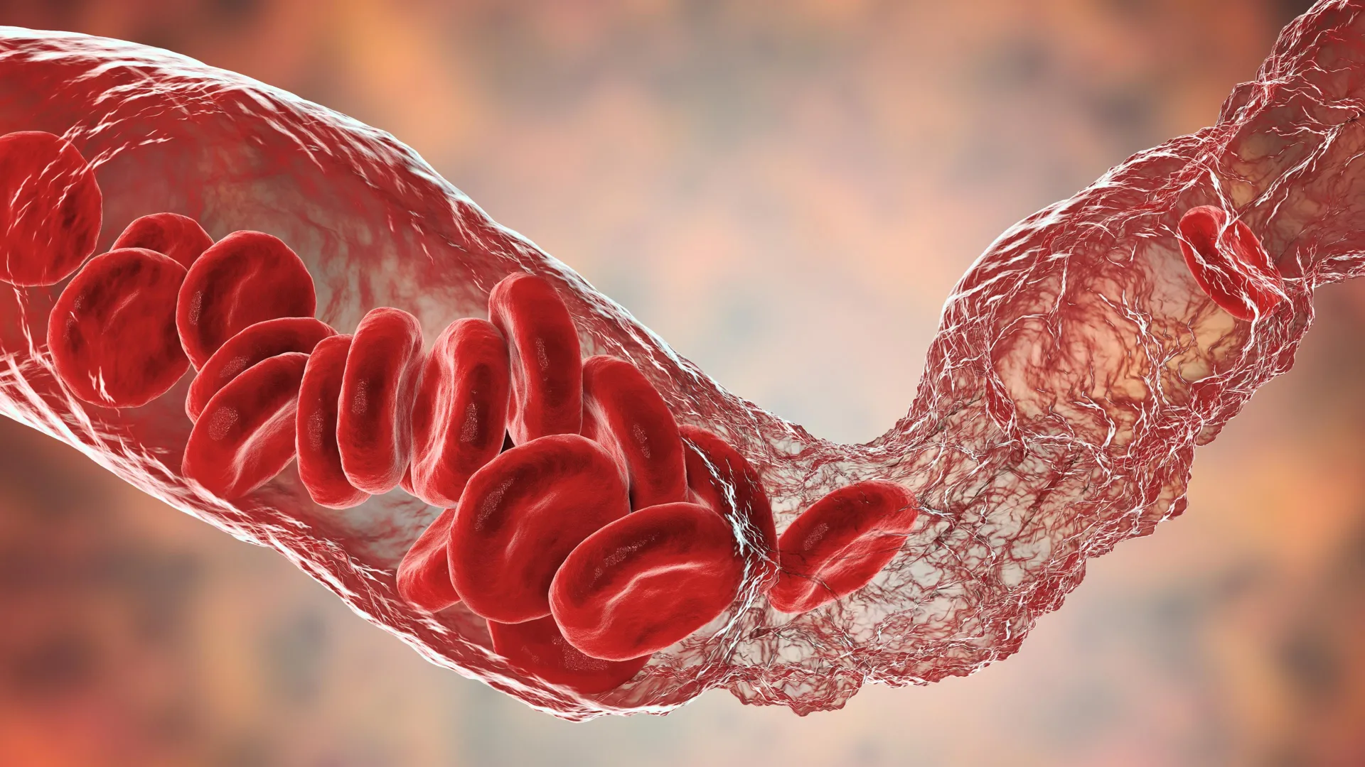 Long COVID may be fueled by inflammation and tiny clots
