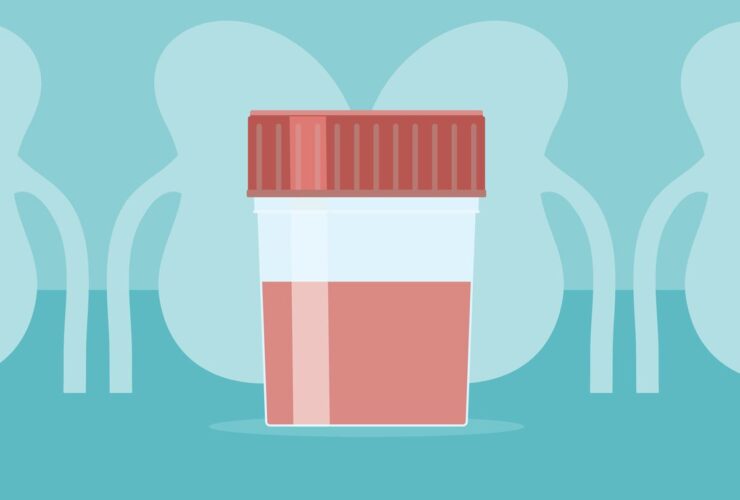 The IgAN Post-Infection Flare: Your Step-by-Step Action Plan