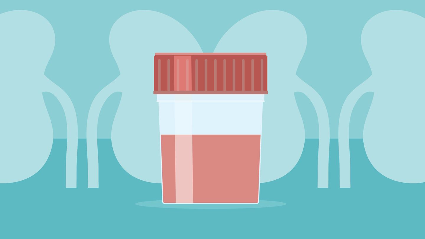 The IgAN Post-Infection Flare: Your Step-by-Step Action Plan