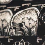 NIH study clearly ties risk of dementia to severe CTE