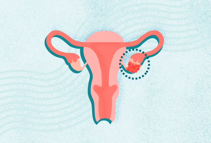 What Is Ovarian Cancer? Symptoms, Causes, Diagnosis, Treatment, and Prevention