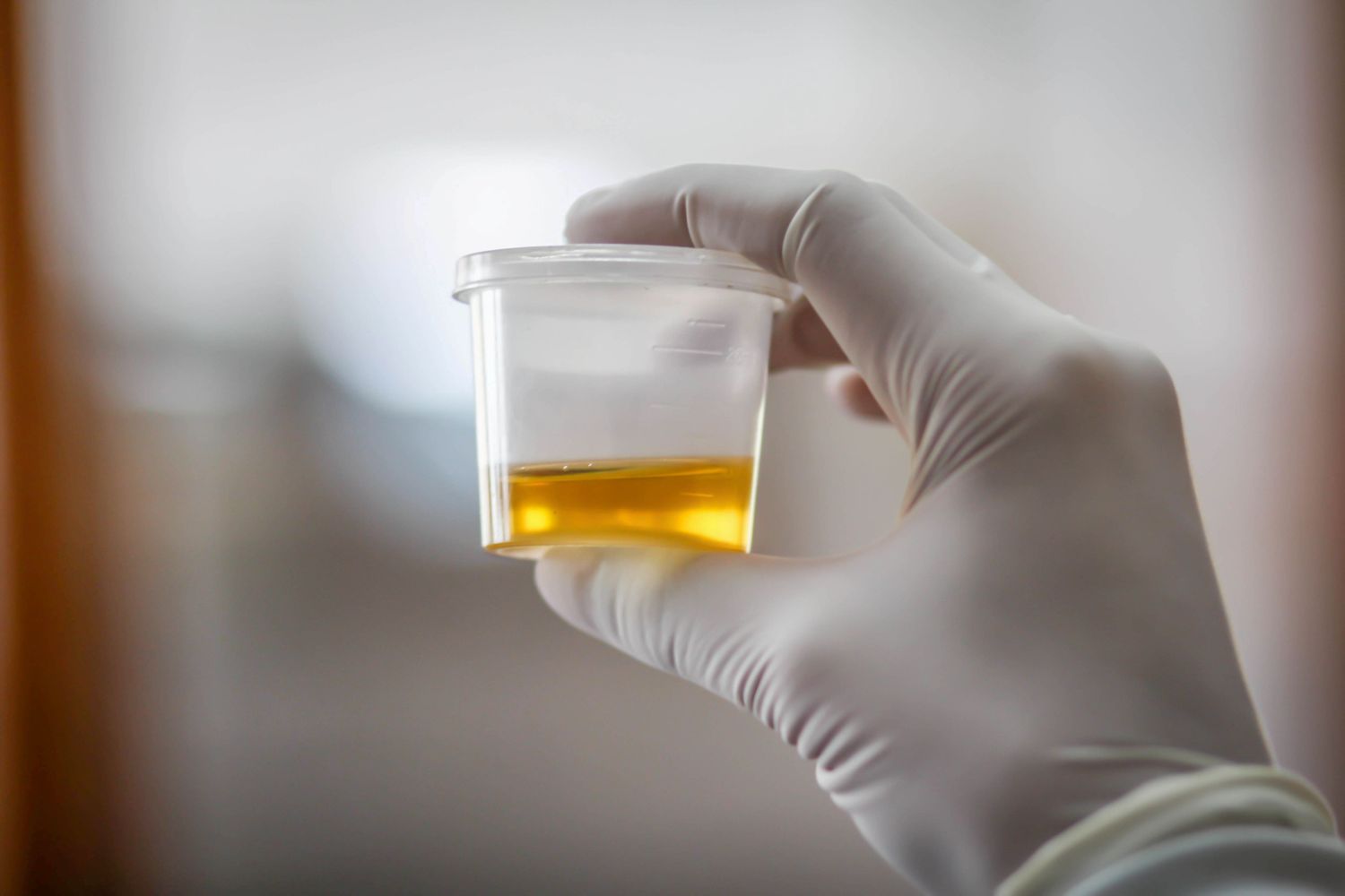 Proteinuria in Complement 3 Glomerulopathy: Why It Matters