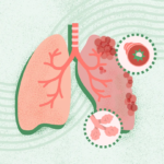 What Is COPD? Symptoms, Causes, Diagnosis, Treatment, and Prevention