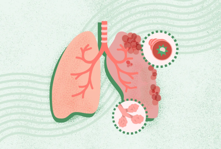 What Is COPD? Symptoms, Causes, Diagnosis, Treatment, and Prevention