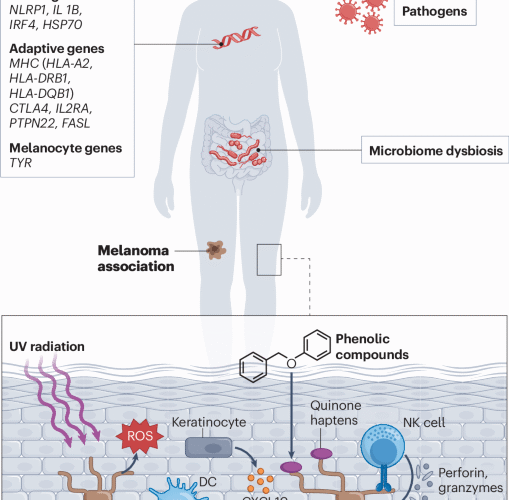 The immunology of vitiligo | Nature Reviews Immunology