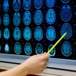 What Causes Huntington’s Disease?