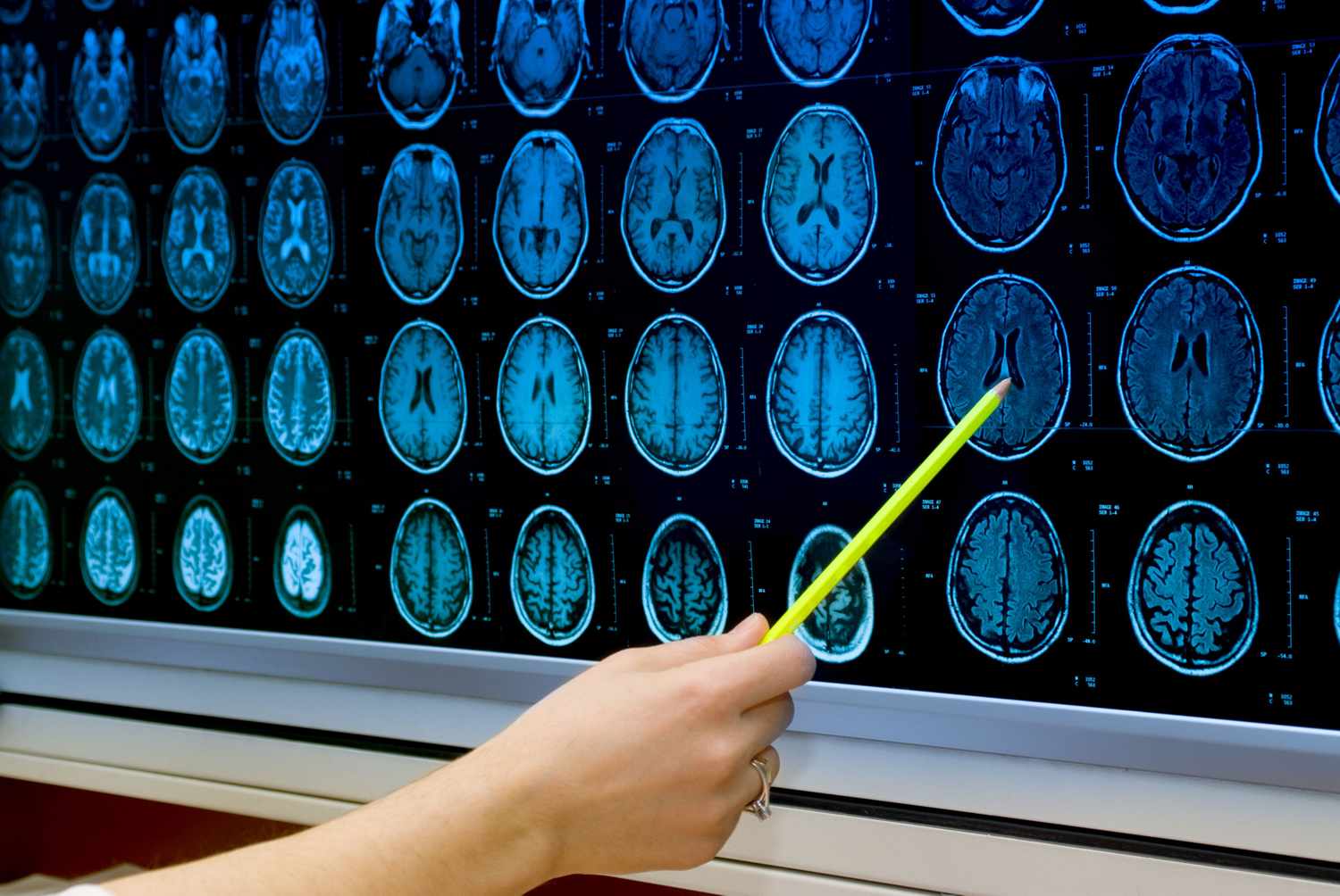 What Causes Huntington’s Disease?