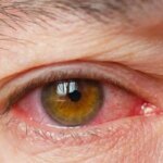 What Is Dry Eye? Symptoms, Causes, Diagnosis, Treatment, and Prevention