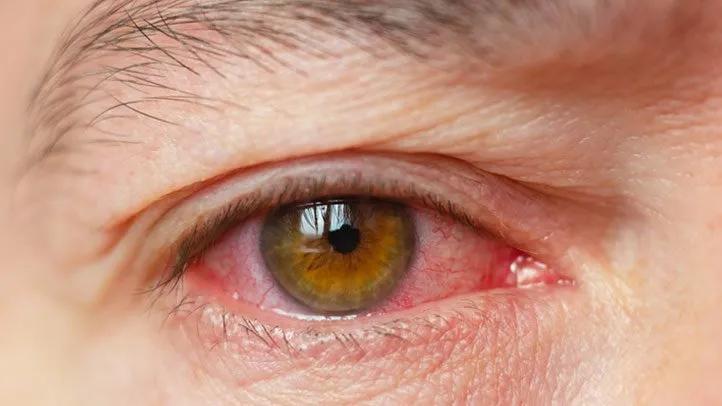 What Is Dry Eye? Symptoms, Causes, Diagnosis, Treatment, and Prevention