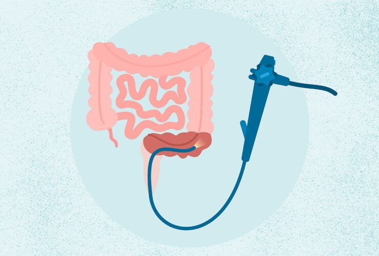 What Is a Sigmoidoscopy?