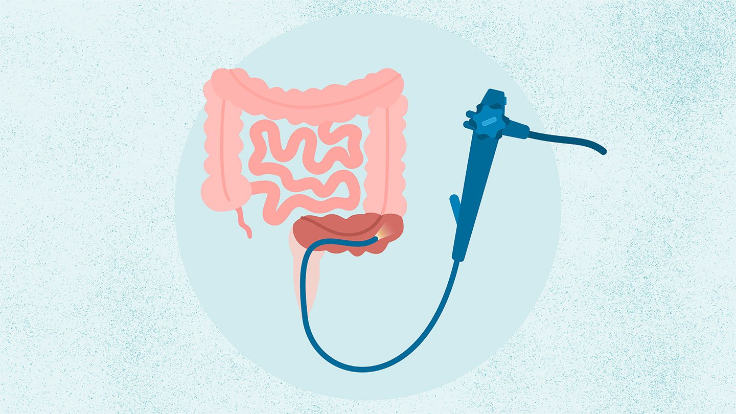 What Is a Sigmoidoscopy?