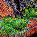 Why chronic gut inflammation can turn into colon cancer