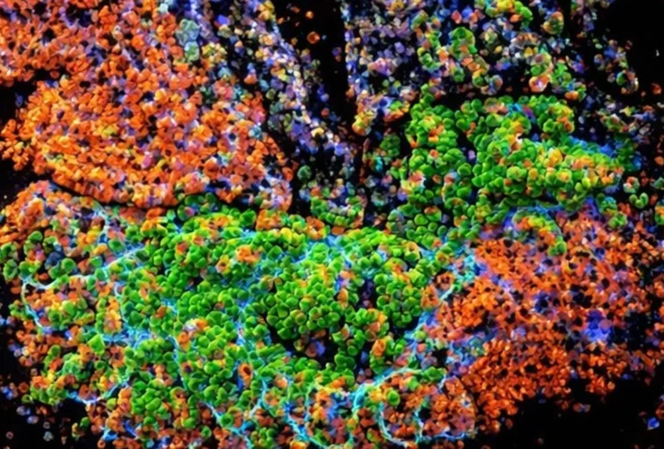 Why chronic gut inflammation can turn into colon cancer