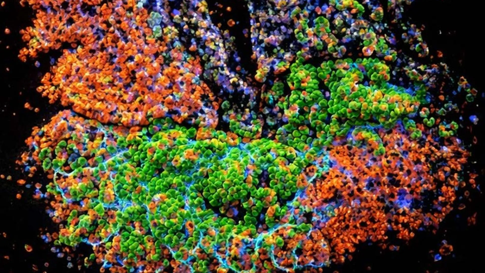 Why chronic gut inflammation can turn into colon cancer