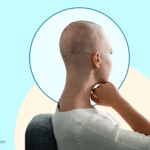 A Subtype Capable of Causing Complete Hair Loss