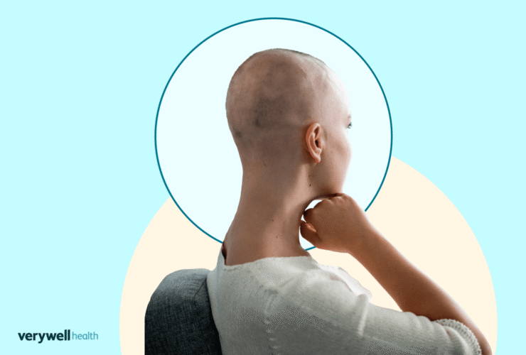 A Subtype Capable of Causing Complete Hair Loss