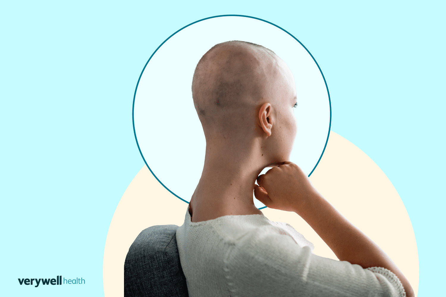 A Subtype Capable of Causing Complete Hair Loss