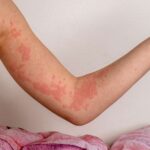 Autoimmune Hives: Symptoms, Causes, and Treatment