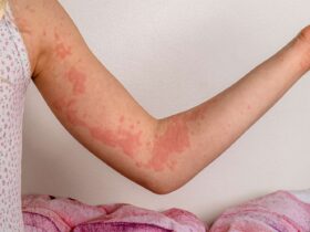 Autoimmune Hives: Symptoms, Causes, and Treatment
