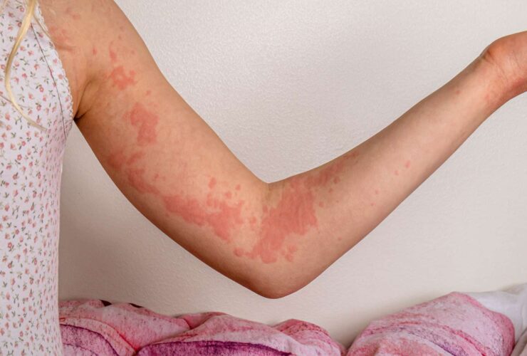 Autoimmune Hives: Symptoms, Causes, and Treatment
