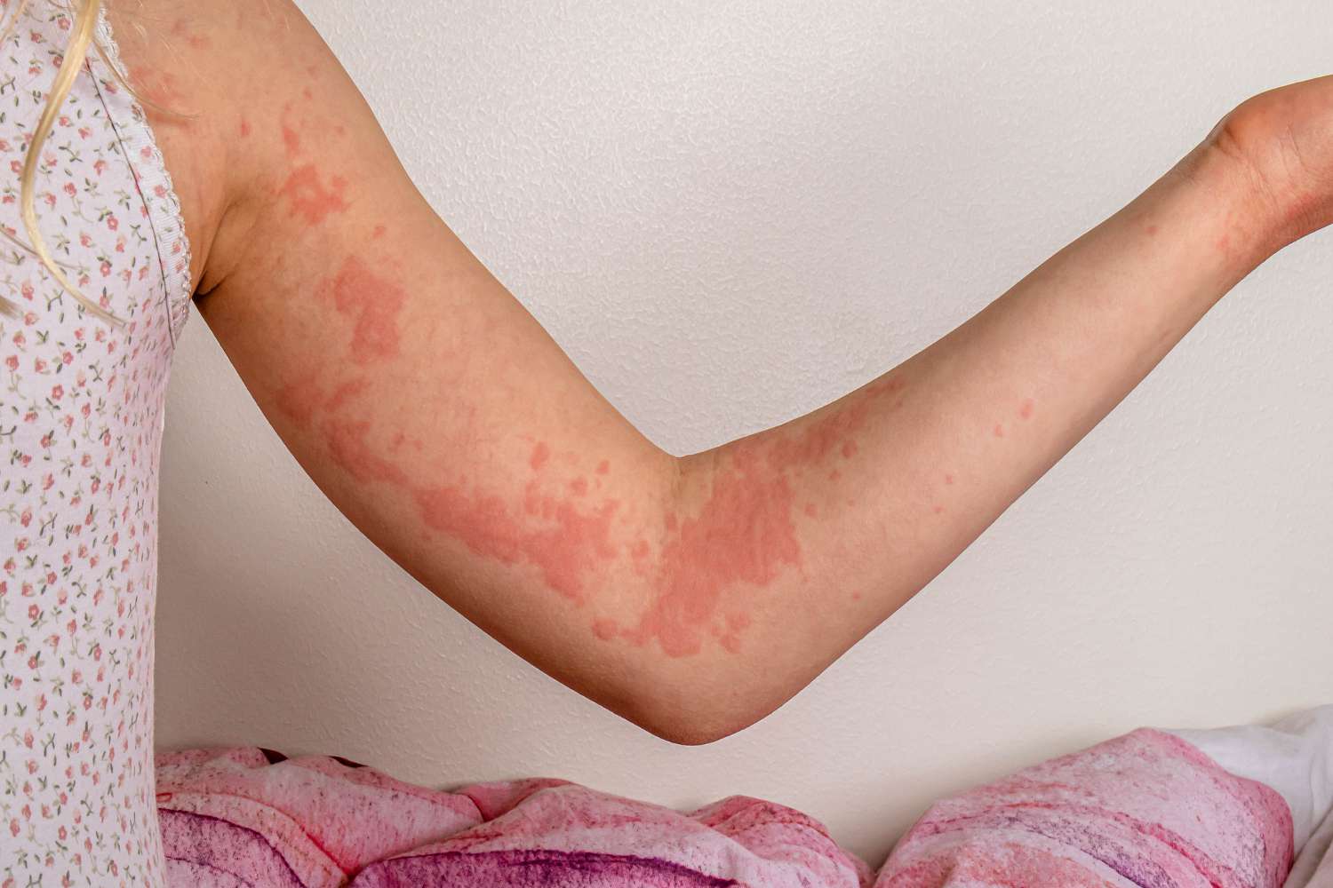 Autoimmune Hives: Symptoms, Causes, and Treatment