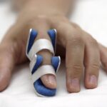 Broken Finger Symptoms and Treatment